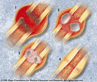 Graphic of fracture healing process