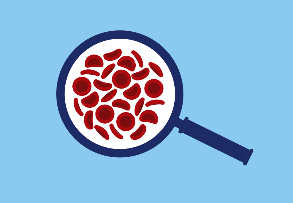 Magnifying glass showing healthy red blood cells and red blood cells showing sickle cell trait